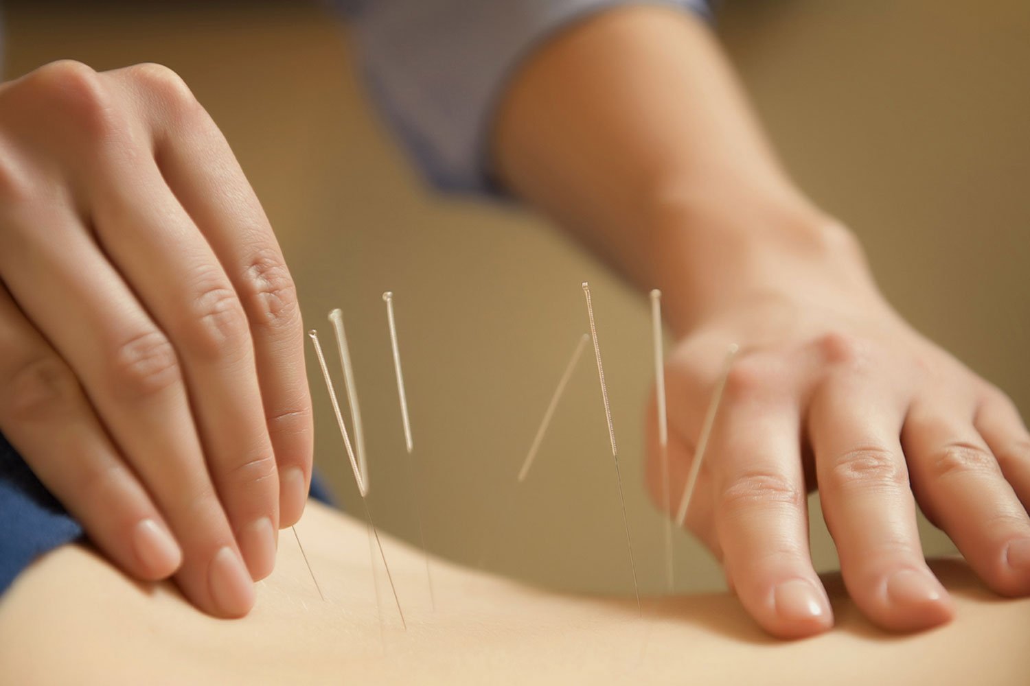 A photograph of acupuncture needles being applied to an area of the body.